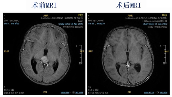 手術(shù)前后造影對(duì)比。重醫(yī)附屬兒童醫(yī)院供圖