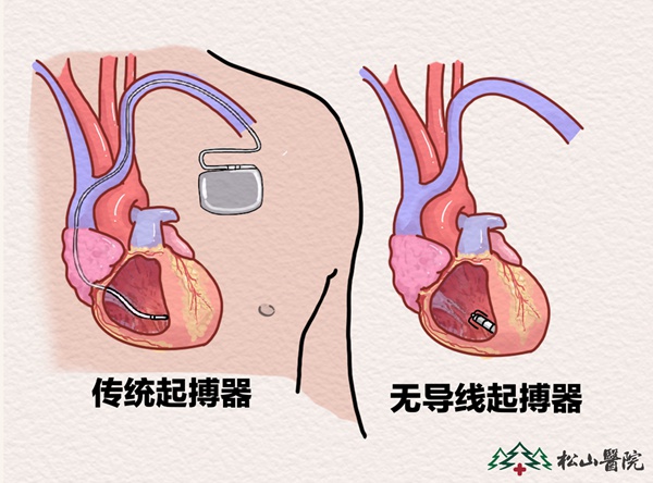 傳統(tǒng)起搏器與無導線起搏器對比。重慶松山醫(yī)院供圖