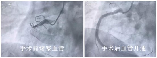 手術(shù)前后血管狀態(tài)。重慶康心醫(yī)院供圖