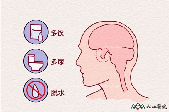 中樞性尿崩癥。重慶松山醫(yī)院供圖