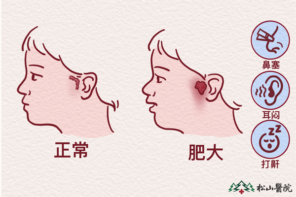 腺樣體肥大。重慶松山醫(yī)院供圖