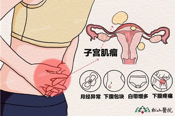 子宮肌瘤癥狀。重慶松山醫(yī)院供圖