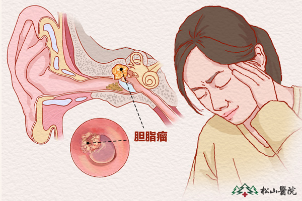 膽脂瘤。重慶松山醫(yī)院供圖