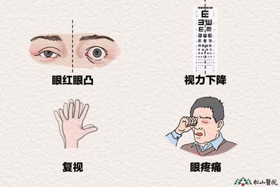 甲狀腺相關(guān)眼病的常見癥狀。重慶松山醫(yī)院供圖