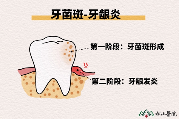 牙齦炎的形成過(guò)程。重慶松山醫(yī)院供圖