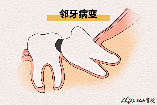 鄰牙病變。重慶松山醫(yī)院供圖