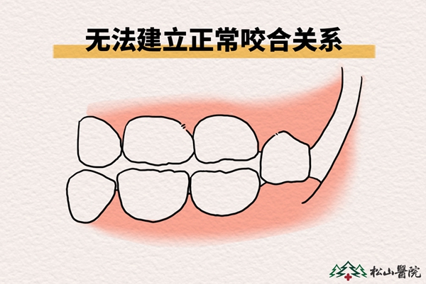 無法建立正常咬合關系。重慶松山醫(yī)院供圖