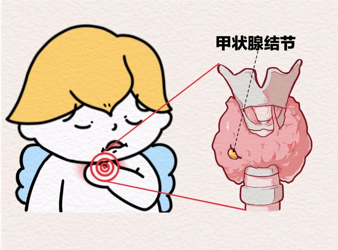 甲狀腺結節(jié)。重慶松山醫(yī)院供圖