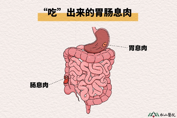 胃腸息肉。重慶松山醫(yī)院供圖