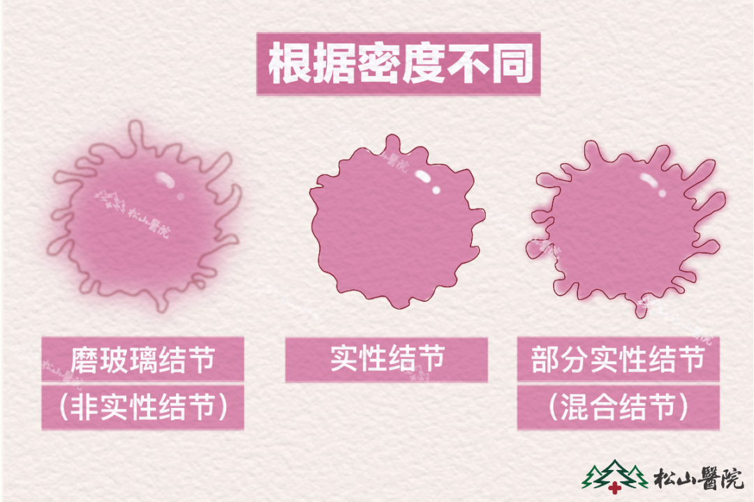 肺結(jié)節(jié)。重慶松山醫(yī)院供圖