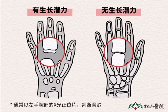 骨齡監(jiān)測。重慶松山醫(yī)院供圖
