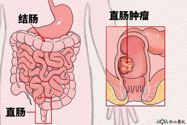 直腸腫瘤示意圖。重慶松山醫(yī)院供圖