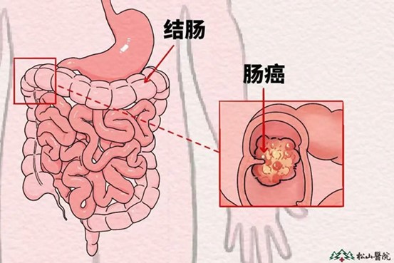 示意圖。重慶松山醫(yī)院供圖