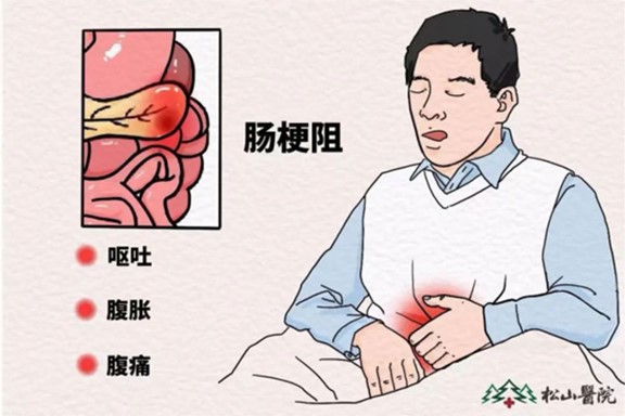 腸梗阻。重慶松山醫(yī)院供圖