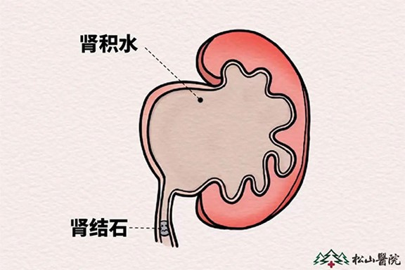 腎結(jié)石的危害。重慶松山醫(yī)院供圖