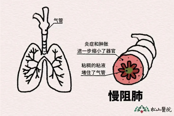 示意圖。重慶松山醫(yī)院供圖