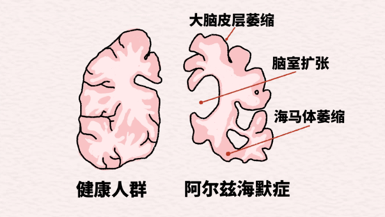 示意圖。重慶松山醫(yī)院供圖