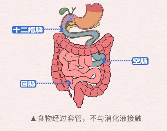 示意圖。重慶松山醫(yī)院供圖
