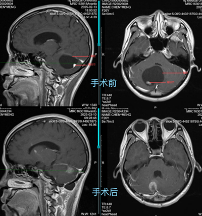 手術(shù)前后MRI對(duì)比。重醫(yī)附屬大學(xué)城醫(yī)院供圖