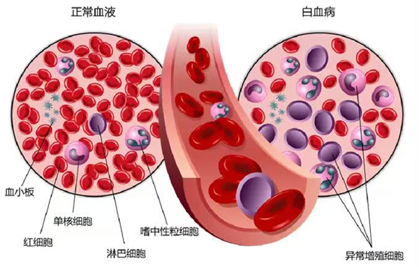 正常血液和白血病血液對比圖。重慶松山醫(yī)院供圖