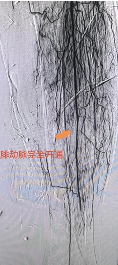 術(shù)后，患者左腿部腓動(dòng)脈血管完全開(kāi)通。重醫(yī)附屬大學(xué)城醫(yī)院供圖